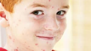 varicelle-bouton